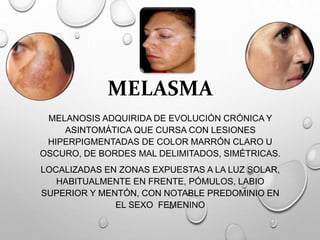 MELASMA
MELANOSIS ADQUIRIDA DE EVOLUCIÓN CRÓNICA Y
ASINTOMÁTICA QUE CURSA CON LESIONES
HIPERPIGMENTADAS DE COLOR MARRÓN CLARO U
OSCURO, DE BORDES MAL DELIMITADOS, SIMÉTRICAS.
LOCALIZADAS EN ZONAS EXPUESTAS A LA LUZ SOLAR,
HABITUALMENTE EN FRENTE, PÓMULOS, LABIO
SUPERIOR Y MENTÓN, CON NOTABLE PREDOMINIO EN
EL SEXO FEMENINO
 
