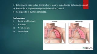 Este sistema nos ayuda a drenar el aire, sangre, pus o líquido del espacio pleural.
 Reestablecer la presión negativa de la cavidad pleural.
 Re-expandir el pulmón colapsado.
Indicado en:
I. Derrames Pleurales.
II. Empiema.
III. Neumotórax.
IV. Hemotórax.
 
