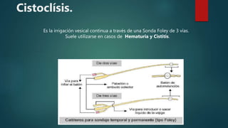 Cistoclísis.
Es la irrigación vesical continua a través de una Sonda Foley de 3 vías.
Suele utilizarse en casos de Hematuria y Cistitis.
 