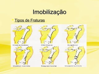 ImobilizaçãoImobilização
 Tipos de Fraturas
“
“!”
 