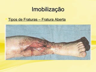 ImobilizaçãoImobilização
 Tipos de Fraturas – Fratura Aberta
 