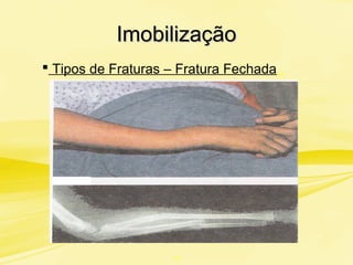 ImobilizaçãoImobilização
 Tipos de Fraturas – Fratura Fechada
“!”
 