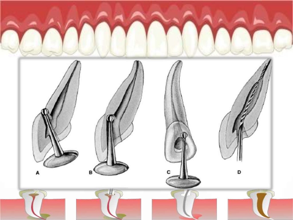 Access Cavity Preparation in Maxillary Lateral Incisor