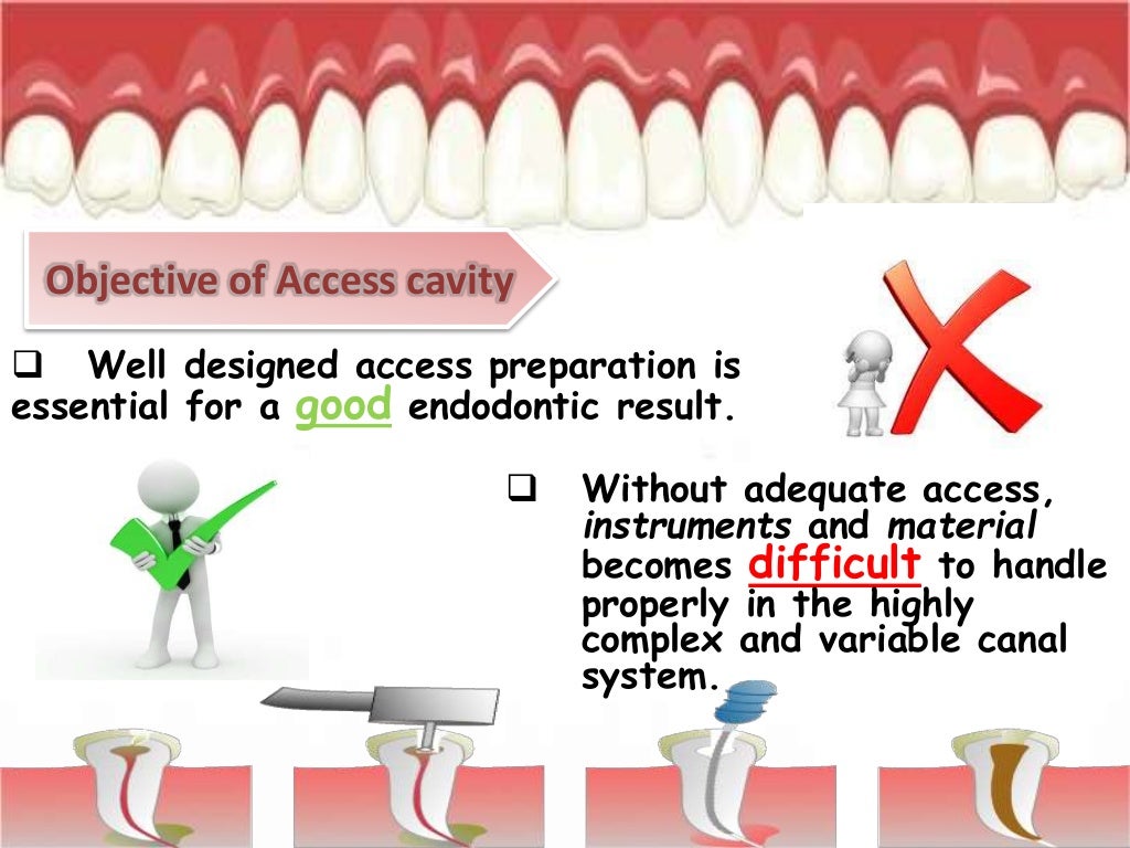 Access Cavity Preparation in Maxillary Lateral Incisor