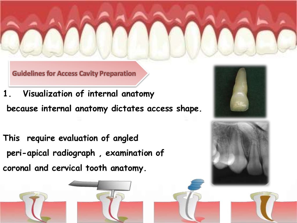 Access Cavity Preparation in Maxillary Lateral Incisor