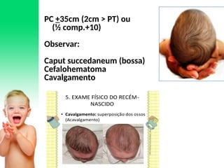 PC +35cm (2cm > PT) ou
(½ comp.+10)
Observar:
Caput succedaneum (bossa)
Cefalohematoma
Cavalgamento
 