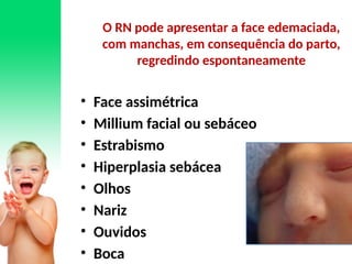 • Face assimétrica
• Millium facial ou sebáceo
• Estrabismo
• Hiperplasia sebácea
• Olhos
• Nariz
• Ouvidos
• Boca
O RN pode apresentar a face edemaciada,
com manchas, em consequência do parto,
regredindo espontaneamente
 