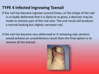 Fungal Nail Infection
• Fungal infection of nails is common. The infection causes
thickened and unsightly nails which some...