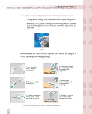 O dispositivo de segurança deve ser parte integral da agulha;
Fornecer uma cobertura/tampa/superfície rígida que permita
que as mãos permaneçam atrás do elemento perfurante ou
cortante.
7.5.2. Dispositivos de segurança em coleta de sangue a vácuo:
GESTÃO DA FASE PRÉ-ANALÍTICA:
RECOMENDAÇÕES DA SOCIEDADE BRASILEIRA DE PATOLOGIA CLÍNICA/MEDICINA LABORATORIAL (SBPC/ML)
24
Figura 4
Procedimento de coleta usando agulha para coleta de sangue a
vácuo, com dispositivo de segurança:
1- Abra a agulha e
retire a proteção
transparente
2- Rosqueie a agulha
no adaptador
3- Levante o dispositivo
de segurança e retire
a proteção da agulha
4- Observe que o bisel
ficou voltado para cima
Puncione a veia
do paciente
5- Após a coleta,
acione imediatamente
o dispositivo de
segurança
6- Descarte o conjunto
em um descartador
para perfurocortantes
Figura 5: Recomendações para uso de agulha com dispositivo de segurança.
 