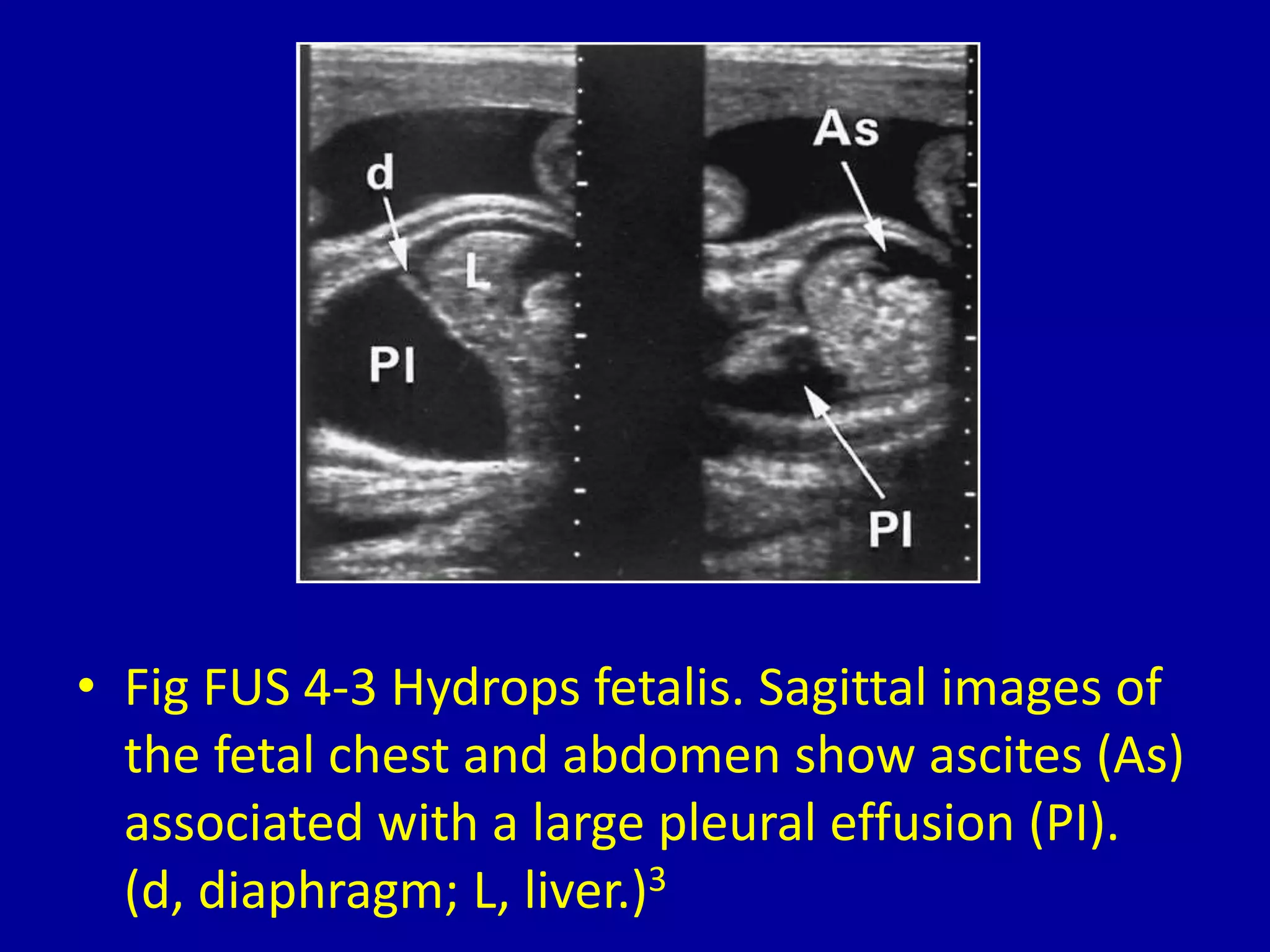 4 Fetal Ascites CLINICAL IMAGAGING AN ATLAS OF DIFFERENTIAL DAIGNOSIS 