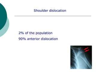Shoulder dislocation
2% of the population
90% anterior dislocation
 