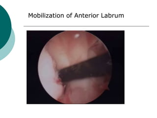 Mobilization of Anterior Labrum
 