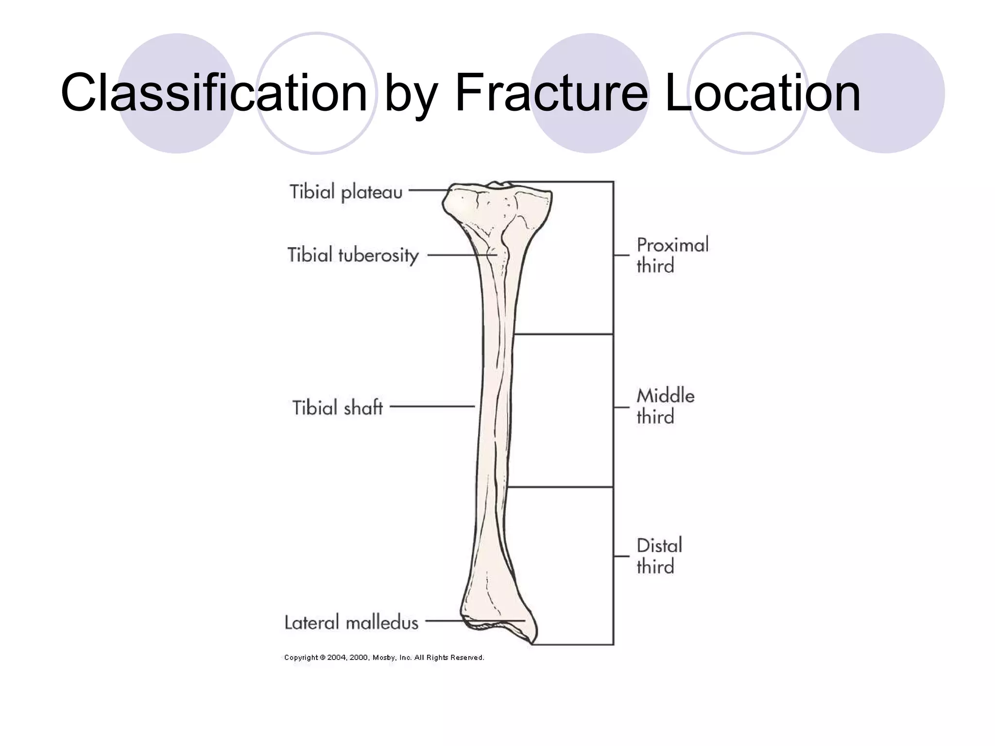 4-fractures-2010-ppt