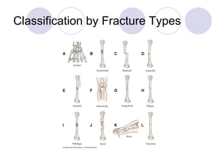 Classification by Fracture Types 
