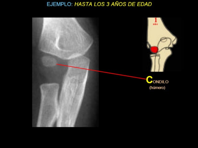 4 fx humero distal niños Dr Miguel Mite