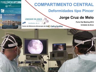 COMPARTIMENTO CENTRAL 
Deformidades tipo Pincer 
Jorge Cruz de Melo 
Porto Hip Meeting 2014 
Unidade da Anca 
Centro de Referencia Artroscopia da Anca 
 
