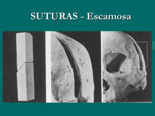 SUTURAS - Escamosa
 