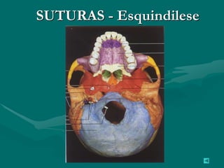 SUTURAS - Esquindilese
 