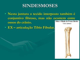 SINDESMOSES
• Nesta juntura o tecido interposto também é
conjuntivo fibroso, mas não ocorrem entre
ossos do crânio.
• EX – articulação Tíbio Fibular.
 