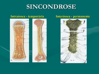 SINCONDROSE
Intraóssea - temporária Interóssea - permanente
 