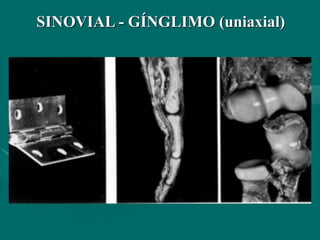 SINOVIAL - GÍNGLIMO (uniaxial)
 