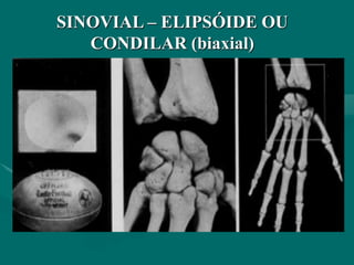 SINOVIAL – ELIPSÓIDE OU
CONDILAR (biaxial)
 