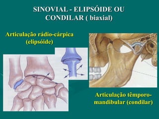 SINOVIAL - ELIPSÓIDE OU
CONDILAR ( biaxial)
Articulação rádio-cárpica
(elipsóide)
Articulação têmporo-
mandibular (condilar)
 