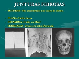 JUNTURAS FIBROSAS
• SUTURAS – São encontradas nos ossos do crânio.
• PLANA- União linear
• ESCAMOSA- União em Bisel
• SERREADAS- União em linha Denteada
 