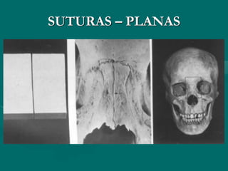 SUTURAS – PLANAS
 