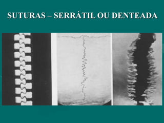 SUTURAS – SERRÁTIL OU DENTEADA
 