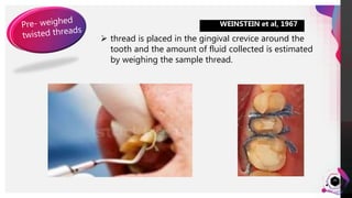 JensMartensson
20
WEINSTEIN et al, 1967
 thread is placed in the gingival crevice around the
tooth and the amount of fluid collected is estimated
by weighing the sample thread.
 