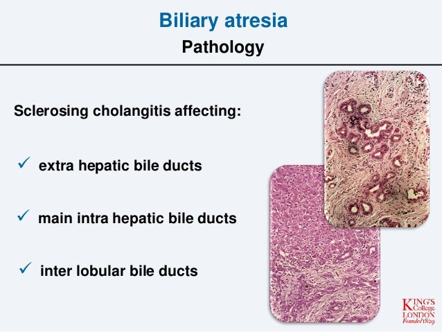 Extrahepatic Biliary Atresia