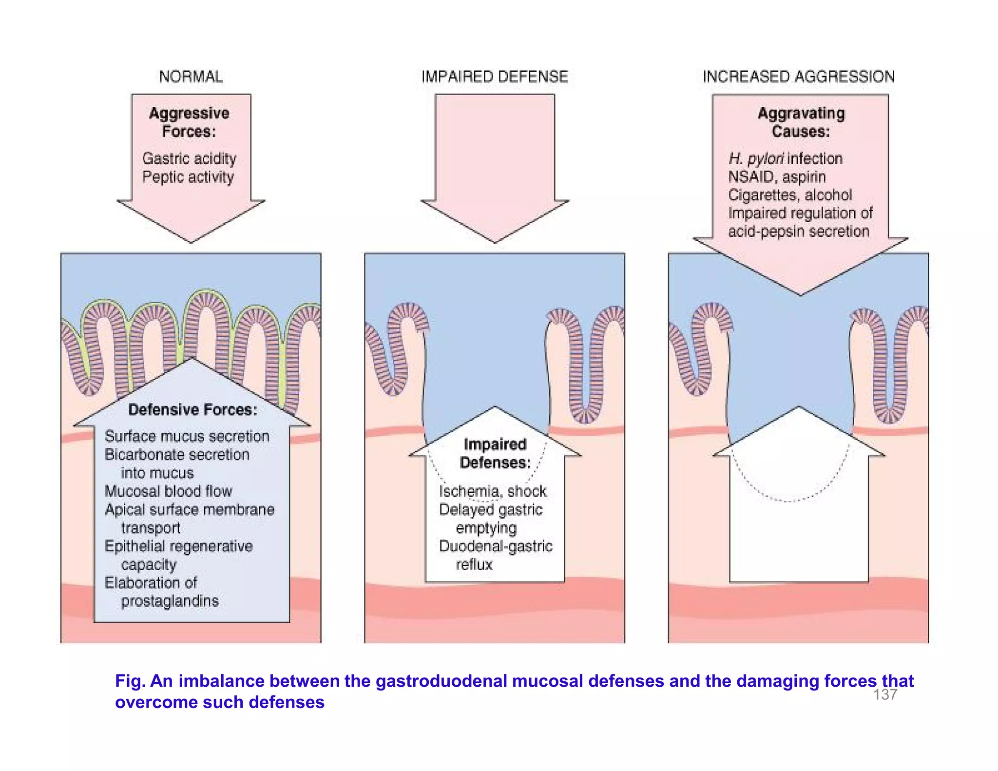 137
Fig. An imbalance between the gastroduodenal mucosal defenses and the
damaging forces that overcome such defenses
Fig. An imbalance between the gastroduodenal mucosal defenses and the damaging forces that
overcome such defenses
 