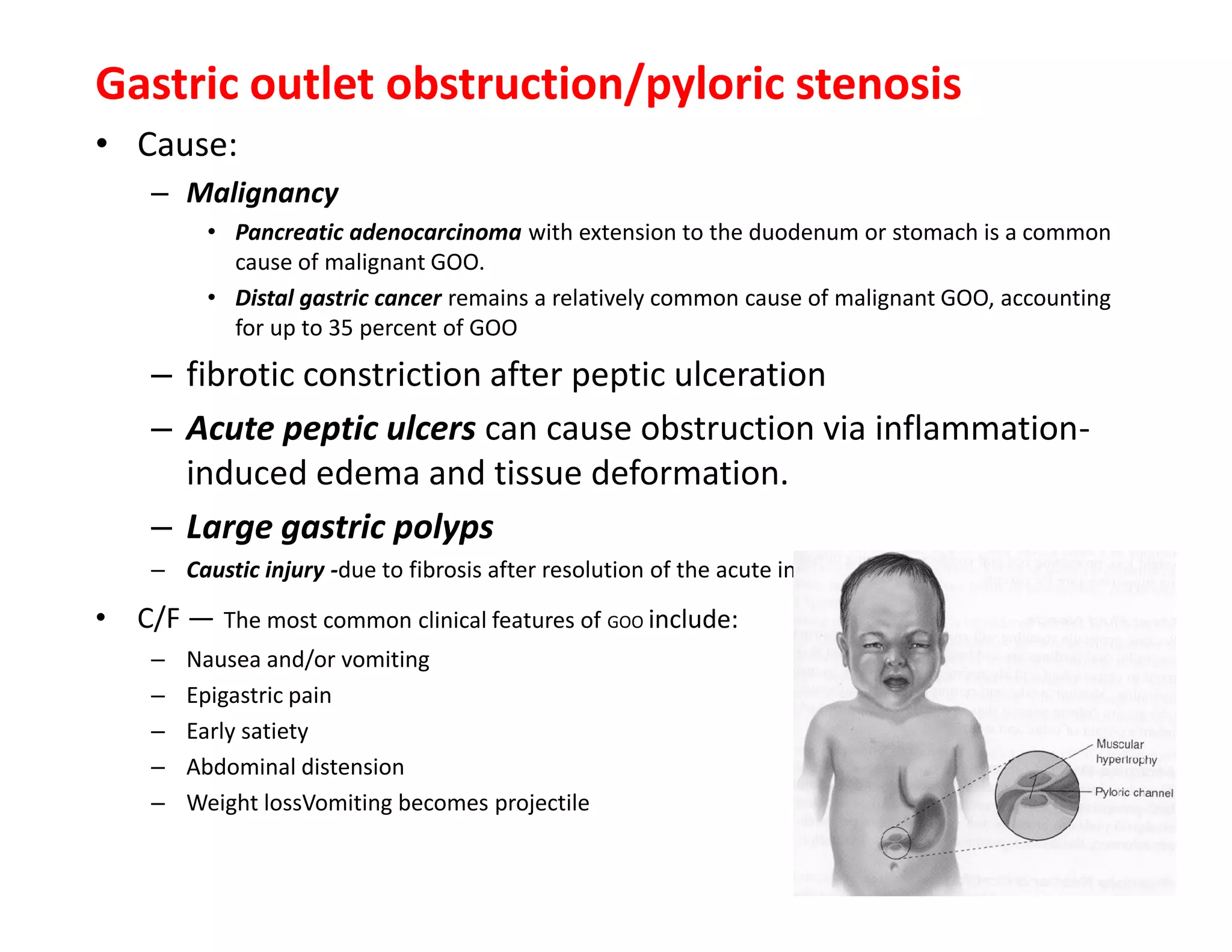 Gastric outlet obstruction/pyloric stenosis
• Cause:
– Malignancy
• Pancreatic adenocarcinoma with extension to the duodenum or stomach is a common
cause of malignant GOO.
• Distal gastric cancer remains a relatively common cause of malignant GOO, accounting
for up to 35 percent of GOO
– fibrotic constriction after peptic ulceration
– Acute peptic ulcers can cause obstruction via inflammation-
induced edema and tissue deformation.
– Large gastric polyps
– Caustic injury -due to fibrosis after resolution of the acute injury and inflammation
• C/F — The most common clinical features of GOO include:
– Nausea and/or vomiting
– Epigastric pain
– Early satiety
– Abdominal distension
– Weight lossVomiting becomes projectile
Gastric outlet obstruction/pyloric stenosis
• Cause:
– Malignancy
• Pancreatic adenocarcinoma with extension to the duodenum or stomach is a common
cause of malignant GOO.
• Distal gastric cancer remains a relatively common cause of malignant GOO, accounting
for up to 35 percent of GOO
– fibrotic constriction after peptic ulceration
– Acute peptic ulcers can cause obstruction via inflammation-
induced edema and tissue deformation.
– Large gastric polyps
– Caustic injury -due to fibrosis after resolution of the acute injury and inflammation
• C/F — The most common clinical features of GOO include:
– Nausea and/or vomiting
– Epigastric pain
– Early satiety
– Abdominal distension
– Weight lossVomiting becomes projectile
143
 