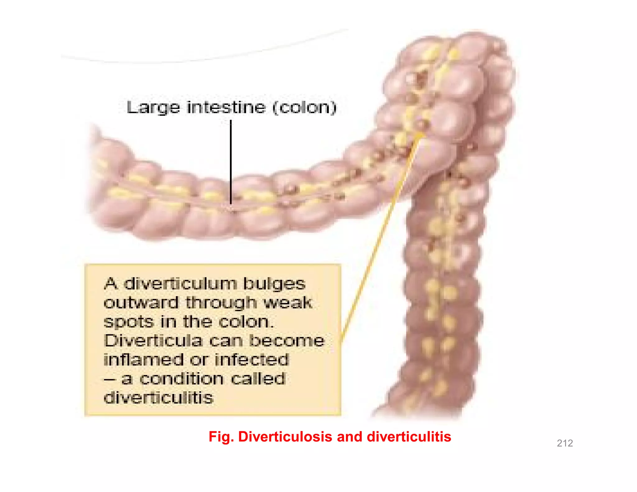 212
Fig. Diverticulosis and diverticulitis
 