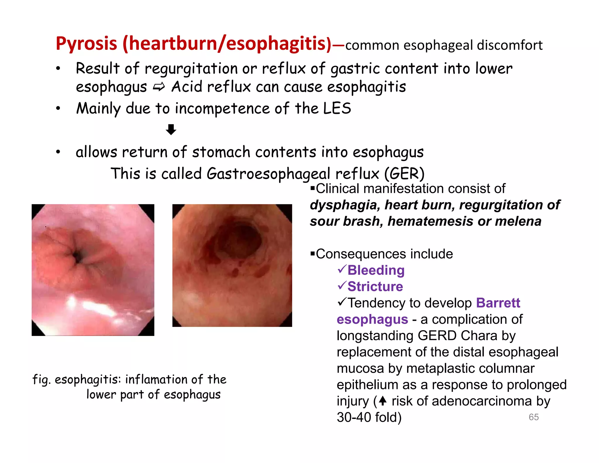 Pyrosis (heartburn/esophagitis)—common esophageal discomfort
• Result of regurgitation or reflux of gastric content into lower
esophagus  Acid reflux can cause esophagitis
• Mainly due to incompetence of the LES

• allows return of stomach contents into esophagus
This is called Gastroesophageal reflux (GER)
Clinical manifestation consist of
dysphagia, heart burn, regurgitation of
sour brash, hematemesis or melena
Consequences include
Bleeding
Stricture
Tendency to develop Barrett
esophagus - a complication of
longstanding GERD Chara by
replacement of the distal esophageal
mucosa by metaplastic columnar
epithelium as a response to prolonged
injury ( risk of adenocarcinoma by
30-40 fold)
fig. esophagitis: inflamation of the
lower part of esophagus
65
Clinical manifestation consist of
dysphagia, heart burn, regurgitation of
sour brash, hematemesis or melena
Consequences include
Bleeding
Stricture
Tendency to develop Barrett
esophagus - a complication of
longstanding GERD Chara by
replacement of the distal esophageal
mucosa by metaplastic columnar
epithelium as a response to prolonged
injury ( risk of adenocarcinoma by
30-40 fold)
 