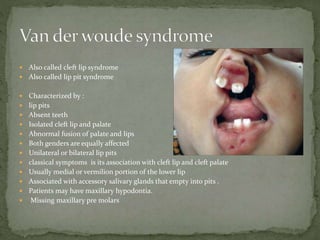  Also called cleft lip syndrome
 Also called lip pit syndrome
 Characterized by :
 lip pits
 Absent teeth
 Isolated cleft lip and palate
 Abnormal fusion of palate and lips
 Both genders are equally affected
 Unilateral or bilateral lip pits
 classical symptoms is its association with cleft lip and cleft palate
 Usually medial or vermilion portion of the lower lip
 Associated with accessory salivary glands that empty into pits .
 Patients may have maxillary hypodontia.
 Missing maxillary pre molars
 