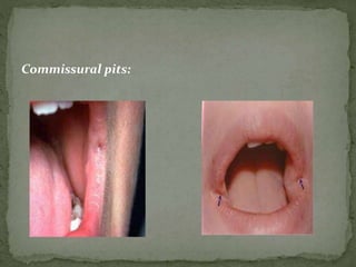 Commissural pits:
 