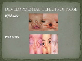 Bifid nose:
Proboscis:
 