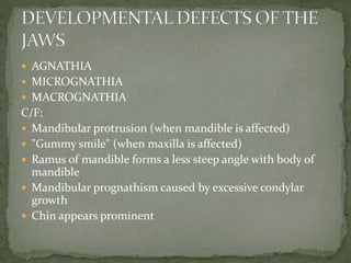  AGNATHIA
 MICROGNATHIA
 MACROGNATHIA
C/F:
 Mandibular protrusion (when mandible is affected)
 "Gummy smile" (when maxilla is affected)
 Ramus of mandible forms a less steep angle with body of
mandible
 Mandibular prognathism caused by excessive condylar
growth
 Chin appears prominent
 