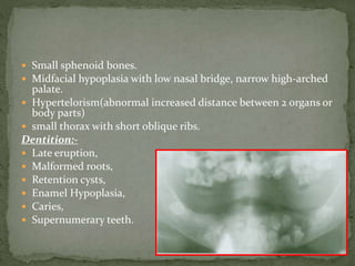  Small sphenoid bones.
 Midfacial hypoplasia with low nasal bridge, narrow high-arched
palate.
 Hypertelorism(abnormal increased distance between 2 organs or
body parts)
 small thorax with short oblique ribs.
Dentition:-
 Late eruption,
 Malformed roots,
 Retention cysts,
 Enamel Hypoplasia,
 Caries,
 Supernumerary teeth.
 
