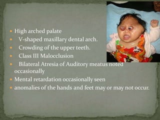  High arched palate
 V-shaped maxillary dental arch.
 Crowding of the upper teeth.
 Class III Malocclusion
 Bilateral Atresia of Auditory meatus noted
occasionally
 Mental retardation occasionally seen
 anomalies of the hands and feet may or may not occur.
 