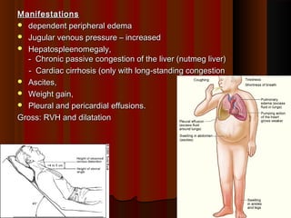ManifestationsManifestations
 dependent peripheral edemadependent peripheral edema
 Jugular venous pressure – increasedJugular venous pressure – increased
 Hepatospleenomegaly,Hepatospleenomegaly,
- Chronic passive congestion of the liver (nutmeg liver)- Chronic passive congestion of the liver (nutmeg liver)
- Cardiac cirrhosis (only with long-standing congestion- Cardiac cirrhosis (only with long-standing congestion
 Ascites,Ascites,
 Weight gain,Weight gain,
 Pleural and pericardial effusions.Pleural and pericardial effusions.
Gross: RVH and dilatationGross: RVH and dilatation
1919
 