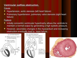 Ventricular outflow obstruction.Ventricular outflow obstruction.
CauseCause
 Hypertension, aortic stenosis (left heart failure)Hypertension, aortic stenosis (left heart failure)
 Pulmonary hypertension, pulmonary valve stenosis (right heartPulmonary hypertension, pulmonary valve stenosis (right heart
failure)failure)
FeatureFeature
 Initially concentric ventricular hypertrophy allows the ventricle toInitially concentric ventricular hypertrophy allows the ventricle to
maintain a normal output by generating a high systolic pressure.maintain a normal output by generating a high systolic pressure.
 However, secondary changes in the myocardium and increasingHowever, secondary changes in the myocardium and increasing
obstruction eventually lead to heart failure.obstruction eventually lead to heart failure.
77
 