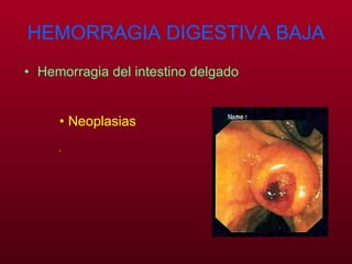 HEMORRAGIA DIGESTIVA BAJA Hemorragia del intestino delgado Neoplasias  