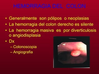 HEMORRAGIA DEL  COLON Generalmente  son pólipos  o neoplasias La hemorragia del colon derecho es silente La  hemorragia masiva  es  por diverticulosis  o angiodisplasia Dx Colonoscopia  Angiografia 
