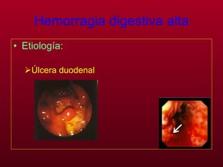 Hemorragia digestiva alta Etiología:   Úlcera duodenal 
