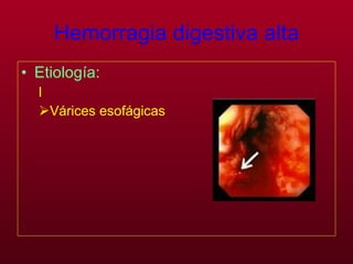 Hemorragia digestiva alta Etiología:   l Várices esofágicas 