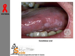 
HIV/SIDA

Candidose oral

Saúde

Escola Cooperativa de Vale S. Cosme

 