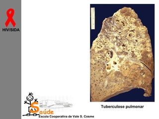 
HIV/SIDA

Saúde

Escola Cooperativa de Vale S. Cosme

Tuberculose pulmonar

 